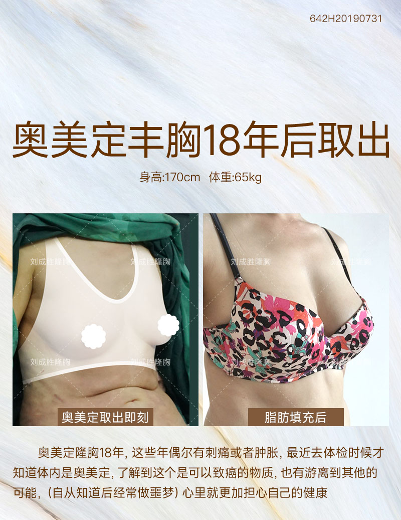 丰体针丰胸后的自我检测：从症状识别潜在问题